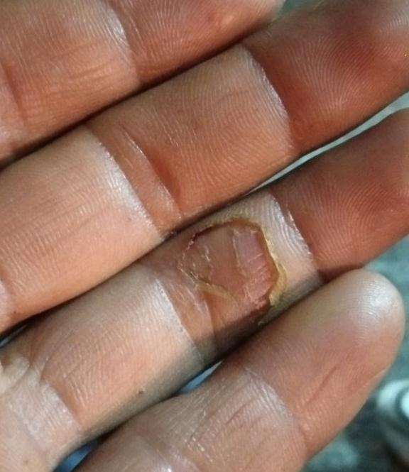 昨天挖到70棵鸦柿下山桩